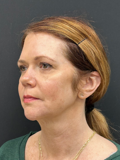 Brow Lift Before & After Patient #12047