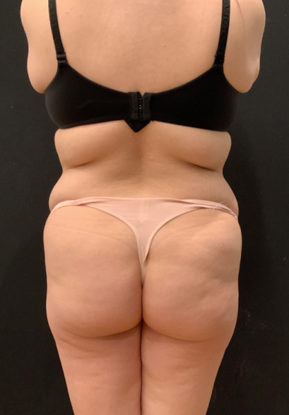 Miami Makeover Before & After Patient #12241