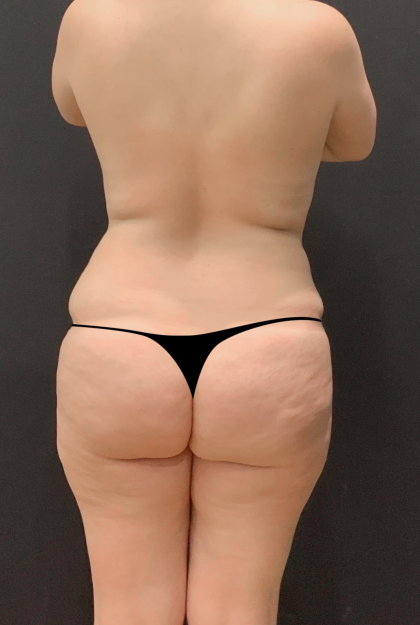 Mommy Makeover Before & After Patient #12226