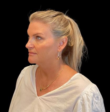 Blepharoplasty Before & After Patient #12229