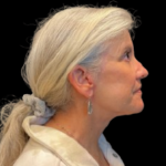 Brow Lift Before & After Patient #12049