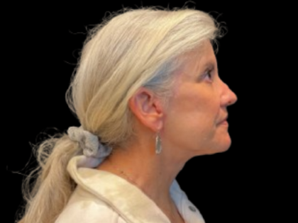 Brow Lift Before & After Patient #12049
