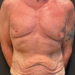 Body Lift Before & After Patient #12650