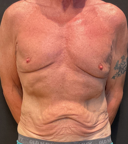 Body Lift Before & After Patient #12650