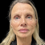 Sculptra Before & After Patient #12648