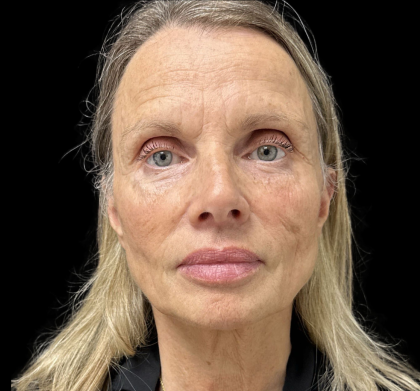 Sculptra Before & After Patient #12648