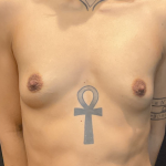 Breast Augmentation Before & After Patient #12643