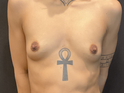 Breast Augmentation Before & After Patient #12643