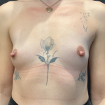 Breast Augmentation Before & After Patient #12646