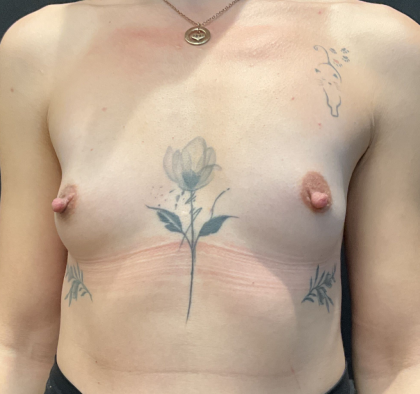 Breast Augmentation Before & After Patient #12646
