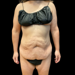 Tummy Tuck Before & After Patient #12649