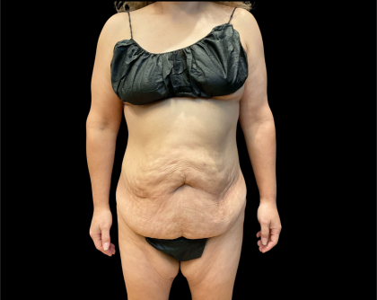 Tummy Tuck Before & After Patient #12649