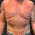 Body Lift Before & After Patient #12650