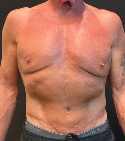 Body Lift Before & After Patient #12650