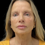 Sculptra Before & After Patient #12648