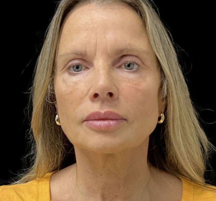 Sculptra Before & After Patient #12648
