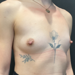 Breast Augmentation Before & After Patient #12646