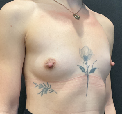 Breast Augmentation Before & After Patient #12646