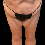 Thigh Lift Before & After Patient #12695