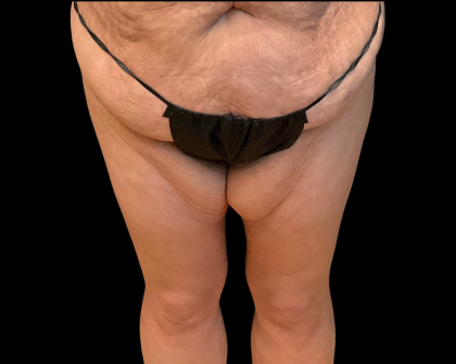 Thigh Lift Before & After Patient #12695