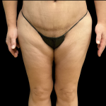 Thigh Lift Before & After Patient #12695