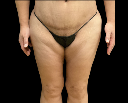 Thigh Lift Before & After Patient #12695