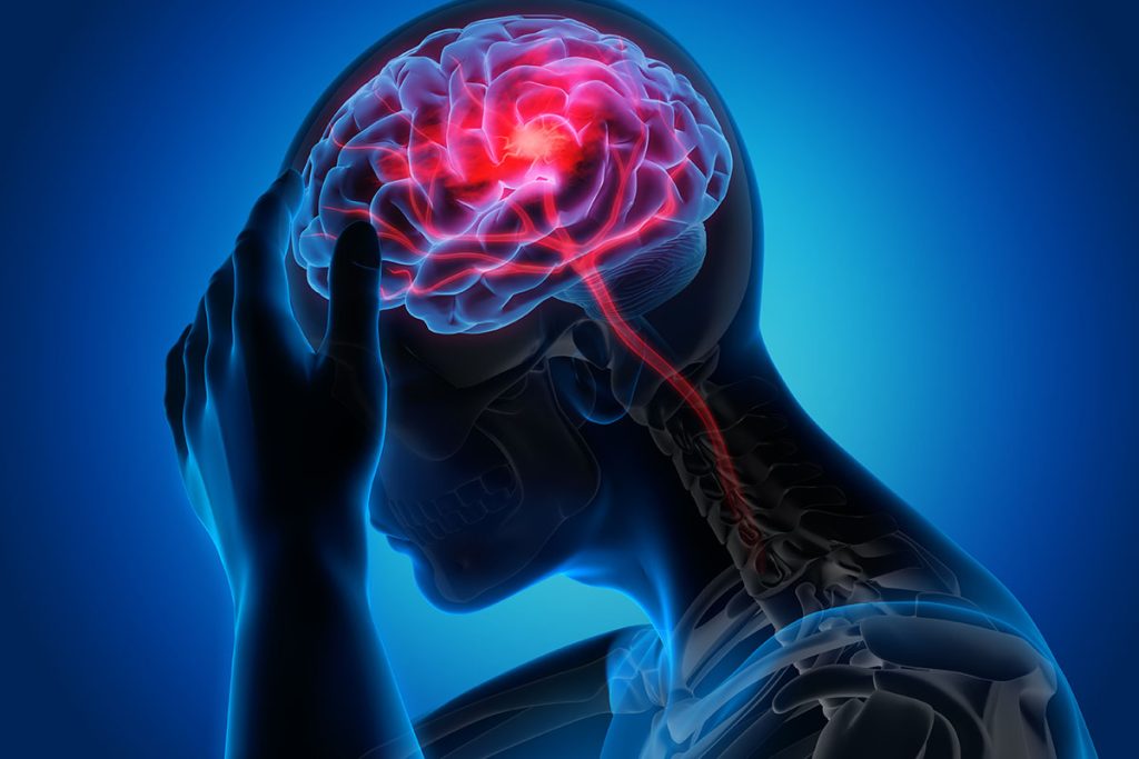 Surgical Relief for Chronic Migraine
