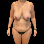 Mommy Makeover Before & After Patient #13589