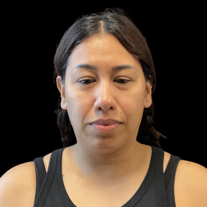 MyEllevate Before & After Patient #13663