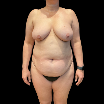Tummy Tuck Before & After Patient #13664
