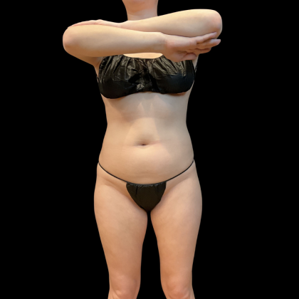 High Definition Liposuction Before & After Patient #13667