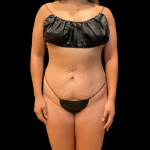Tummy Tuck Before & After Patient #13666