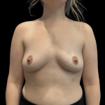 Breast Augmentation Before & After Patient #13669