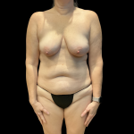 Tummy Tuck Before & After Patient #13672