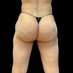 Fat Transfer Before & After Patient #13670