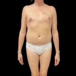 Rib Repositioning Before & After Patient #13675