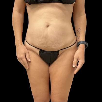 Fat Transfer Before & After Patient #13680