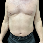 Liposuction Before & After Patient #13685