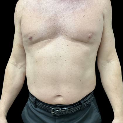 Liposuction Before & After Patient #13685