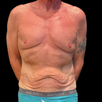 Tummy Tuck Before & After Patient #13683