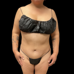 Liposuction Before & After Patient #13684