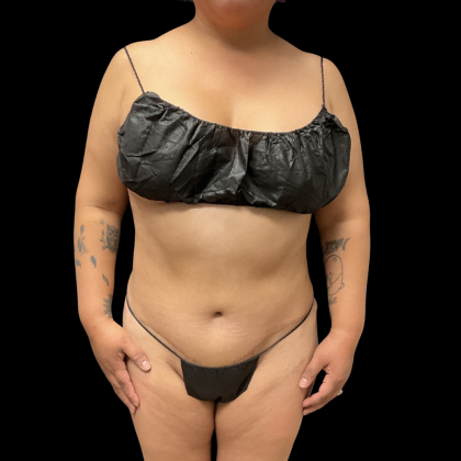 Liposuction Before & After Patient #13684