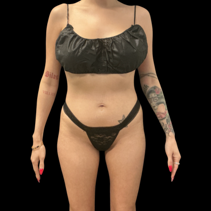 Brazilian Butt Lift Before & After Patient #14199