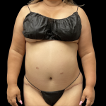 Brazilian Butt Lift Before & After Patient #13626