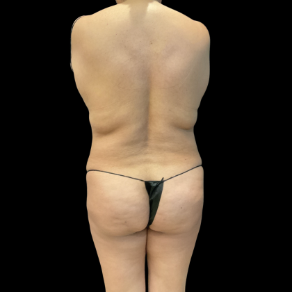 Brazilian Butt Lift Before & After Patient #13588