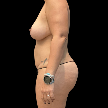 Mommy Makeover Before & After Patient #13589