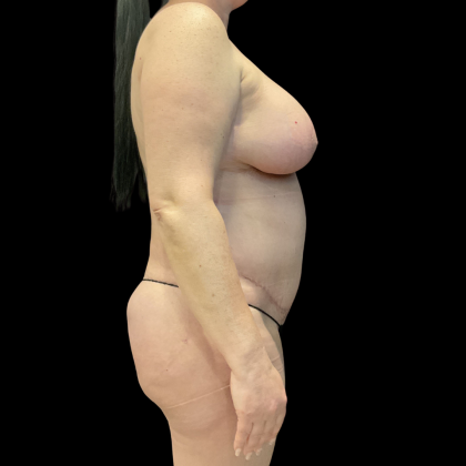 Tummy Tuck Before & After Patient #13664
