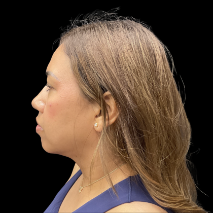 MyEllevate Before & After Patient #13663