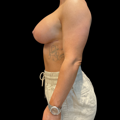 Mastopexy augmentation Before & After Patient #13668