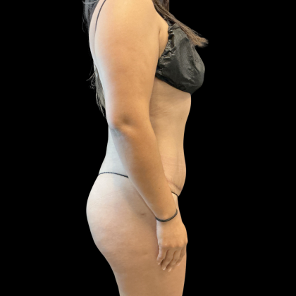Tummy Tuck Before & After Patient #13666